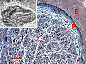 Demyelinized nerve with bands of Büngner (square, inset) . P- perineurium, | E - epineurium. (Human, sural nerve.) Scale 0.2 mm. Demyelinized nerve with bands of Büngner (square, inset) . P- perineurium, | E - epineurium. (Human, sural nerve.) Scale 0.2 mm.